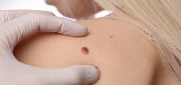 Besplatan pregled ranog otkrivanja melanoma