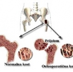 Pregledi gustoće kostiju